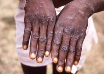 व्हायरसेस च्या शर्यतीत आला नवा मंकीपॉक्स हा व्हायरस | Monkeypox virus and Children